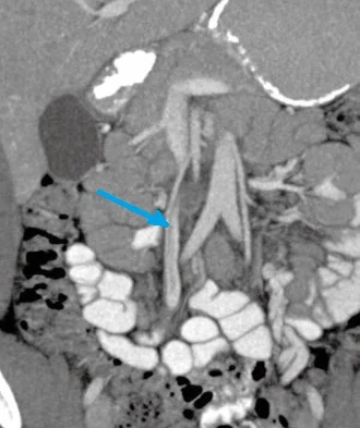 SUPERIOR  MESENTERIC VEIN THROMBOSIS  - NON OCCLUSIVE