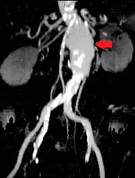 SUPERIOR MESENTERIC ARTERY ANEURYSM