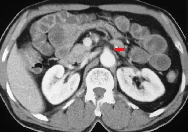 SUPERIOR MESENTERIC ARTERY THROMBOSIS