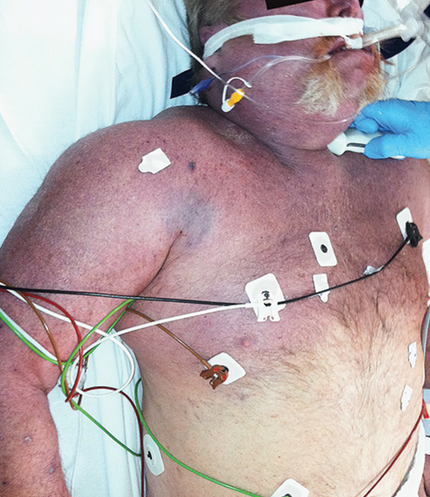 SUPERIOR VENA CAVA SYNDROME 