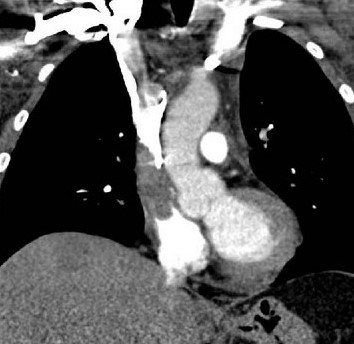 SUPERIOR VENA CAVA THROMBOSIS 