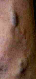 BLEEDING VARICOSE VEINS
