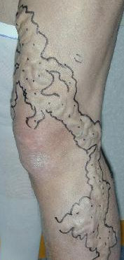 VARICOSE VEINS