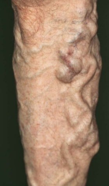 VARICOSE VEINS
