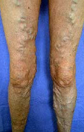 VARICOSE VEINS