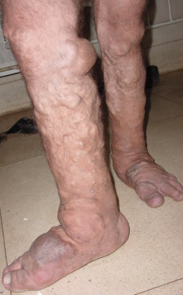 VARICOSE VEINS
