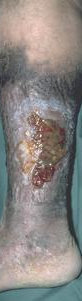 VENOUS ULCER