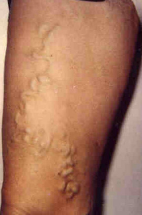 VARICOSE VEINS