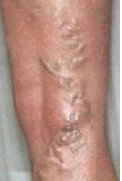 VARICOSE VEINS