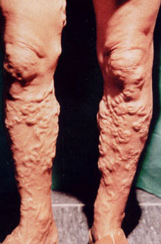 VARICOSE VEINS