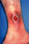 VENOUS ULCER