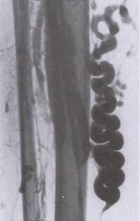 VARICOSE VEINS - VENOGRAPHY