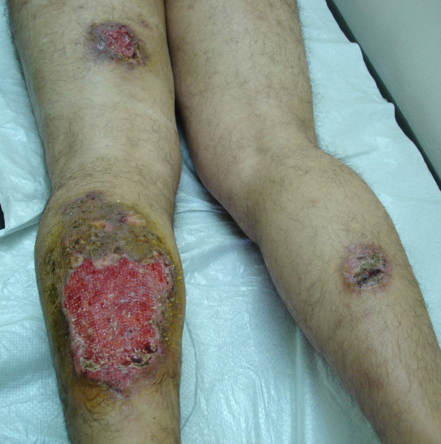 VASCULITIS 