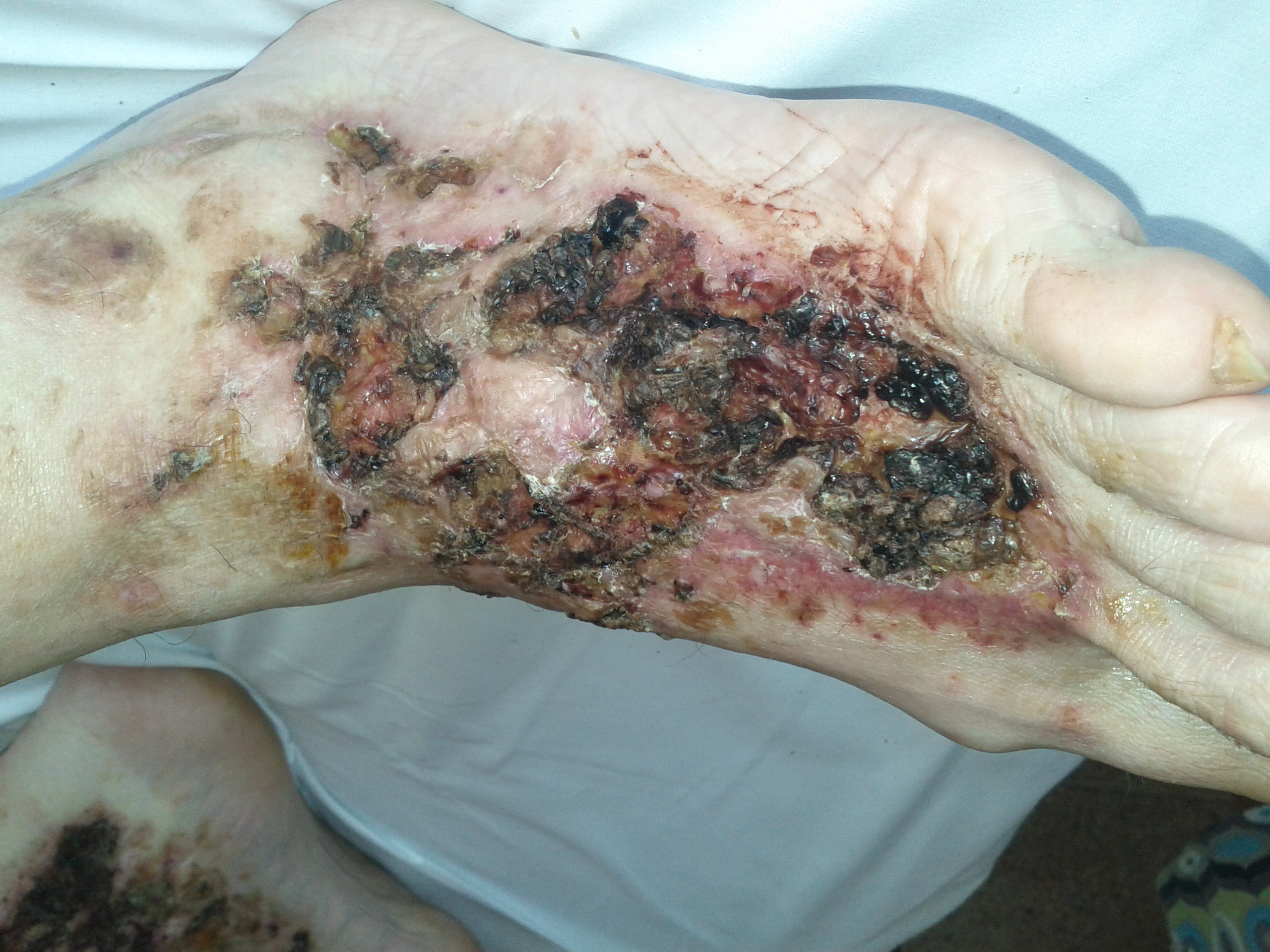 VASCULITIS 