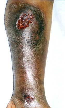 VENOUS ULCER 