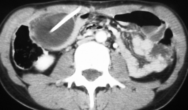 VENTRICULOPERITONEAL SHUNT - PSEUDOCYST