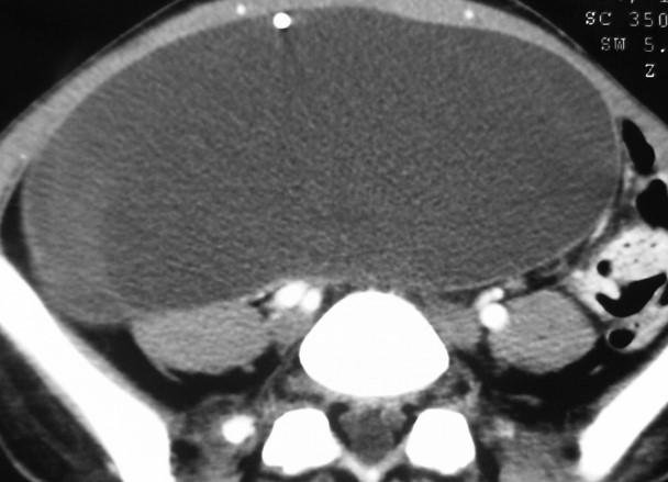 VENTRICULOPERITONEAL SHUNT - PSEUDOCYST 