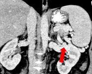 SPLENO-RENAL WARREN SHUNT