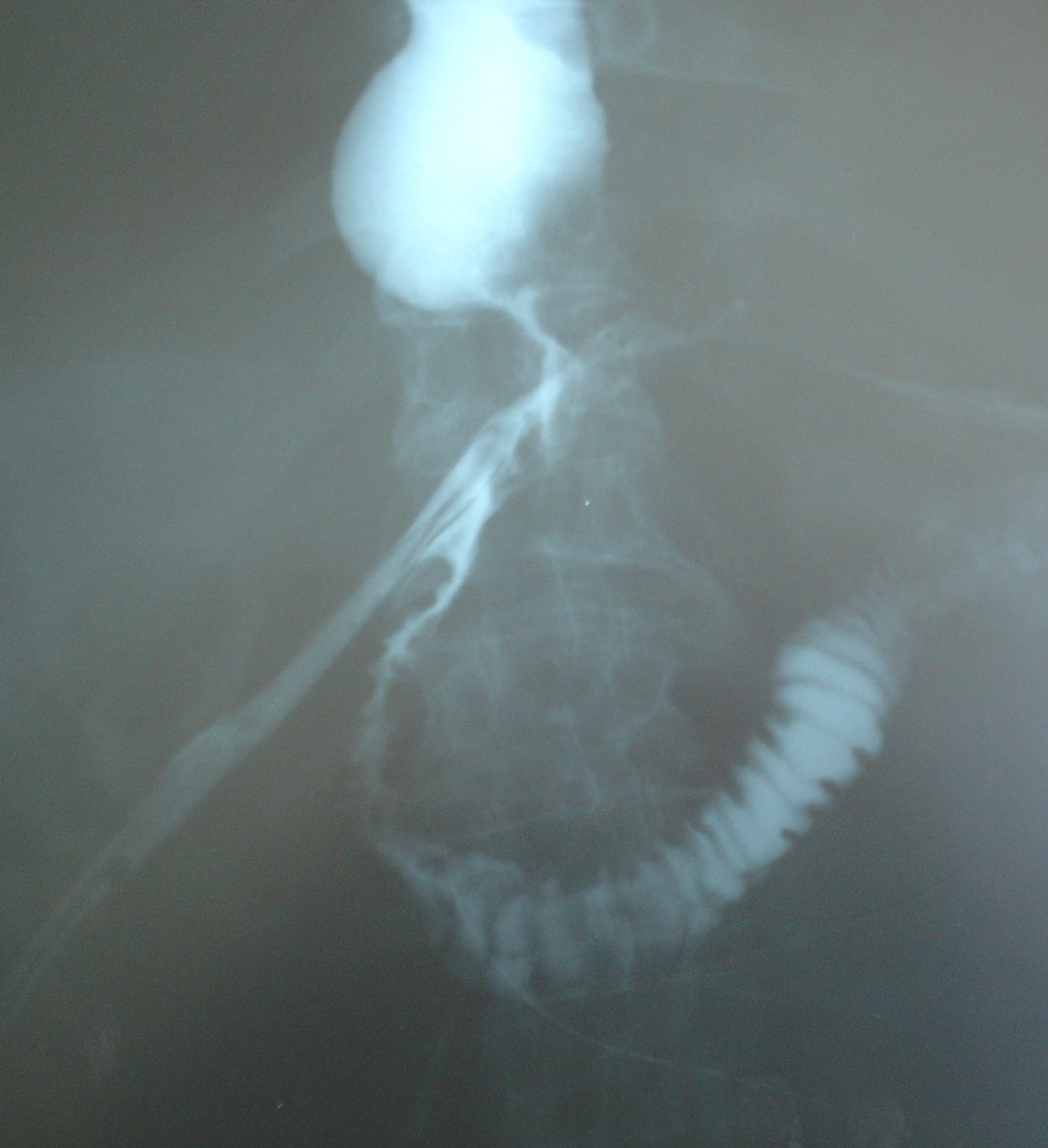 ESOPHAGO-JEJUNAL ANASTOMOSIS LEAK