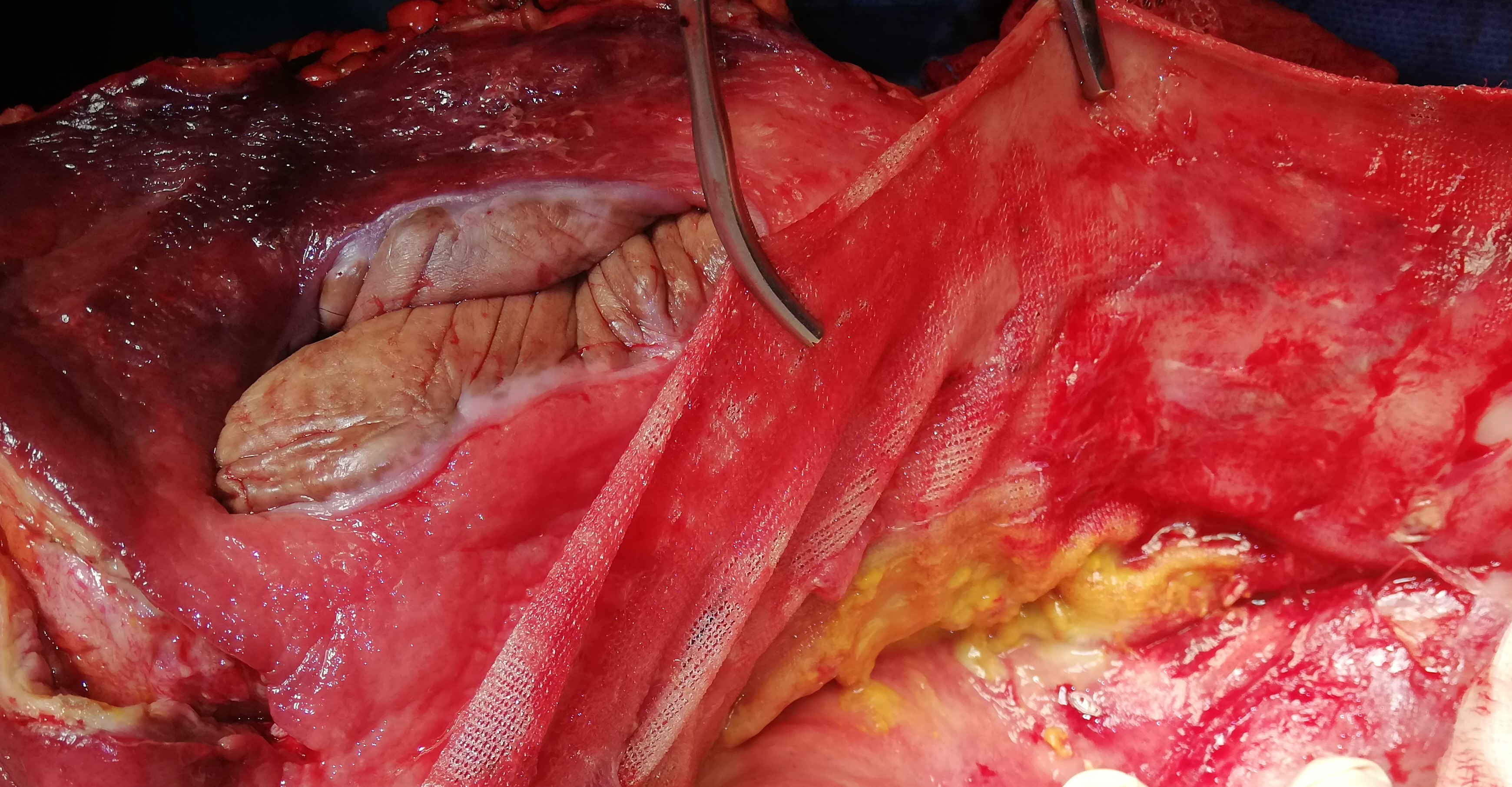 MESH INFECTION 