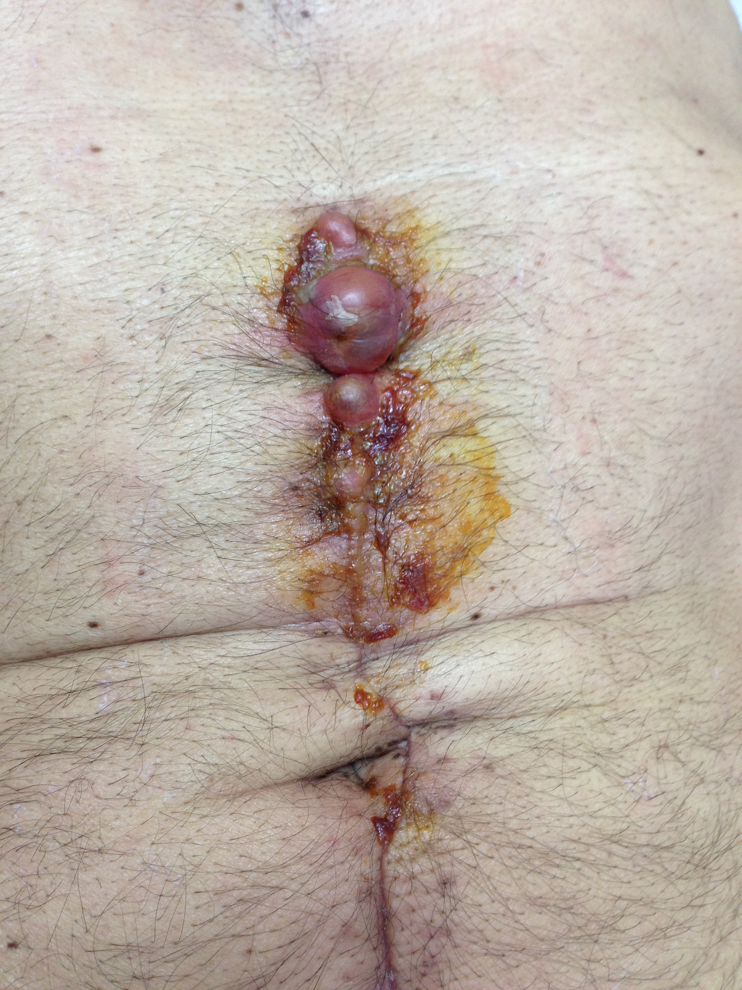 WOUND SUPPURATION