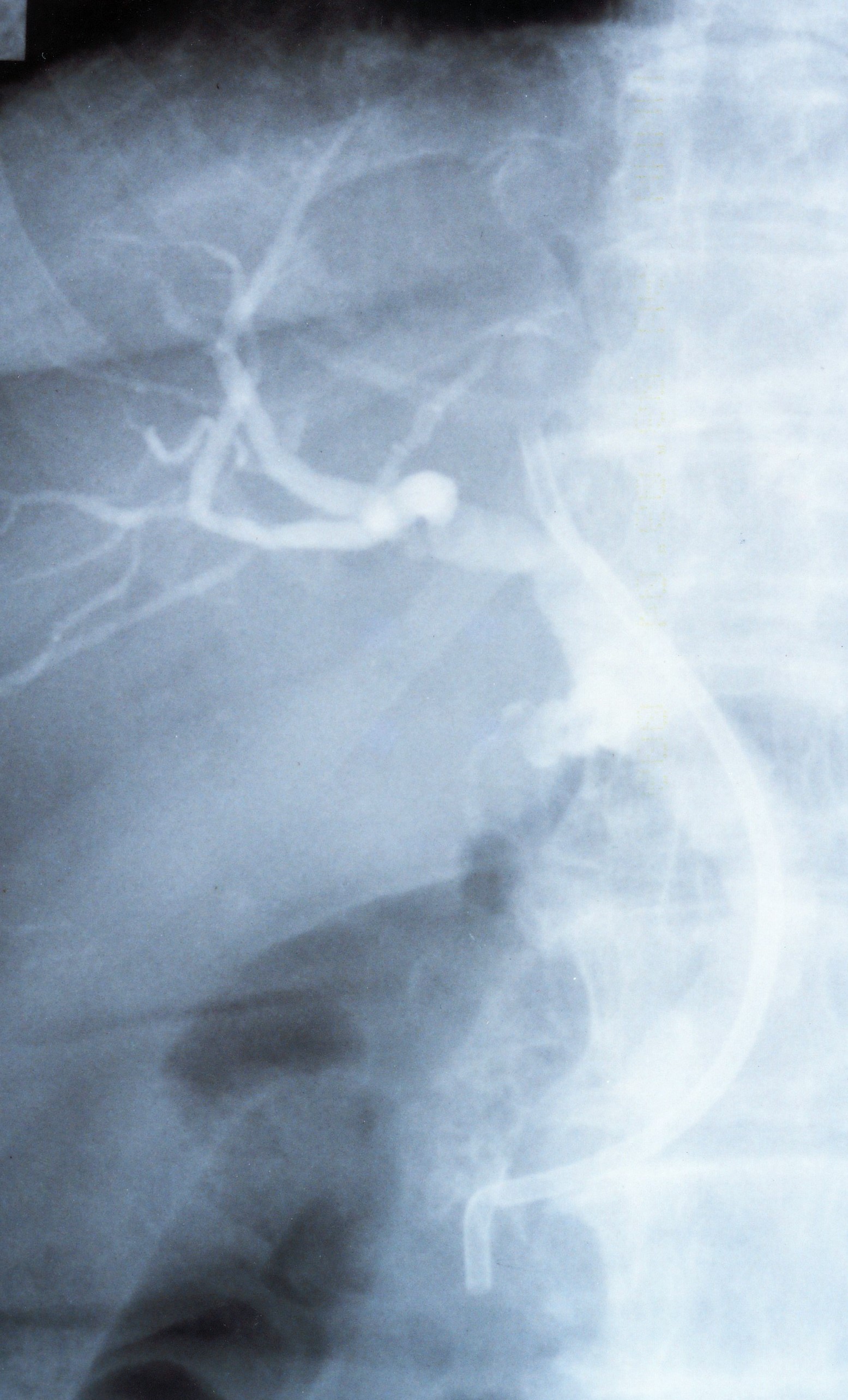 CYSTIC DUCT LEAK - STENT