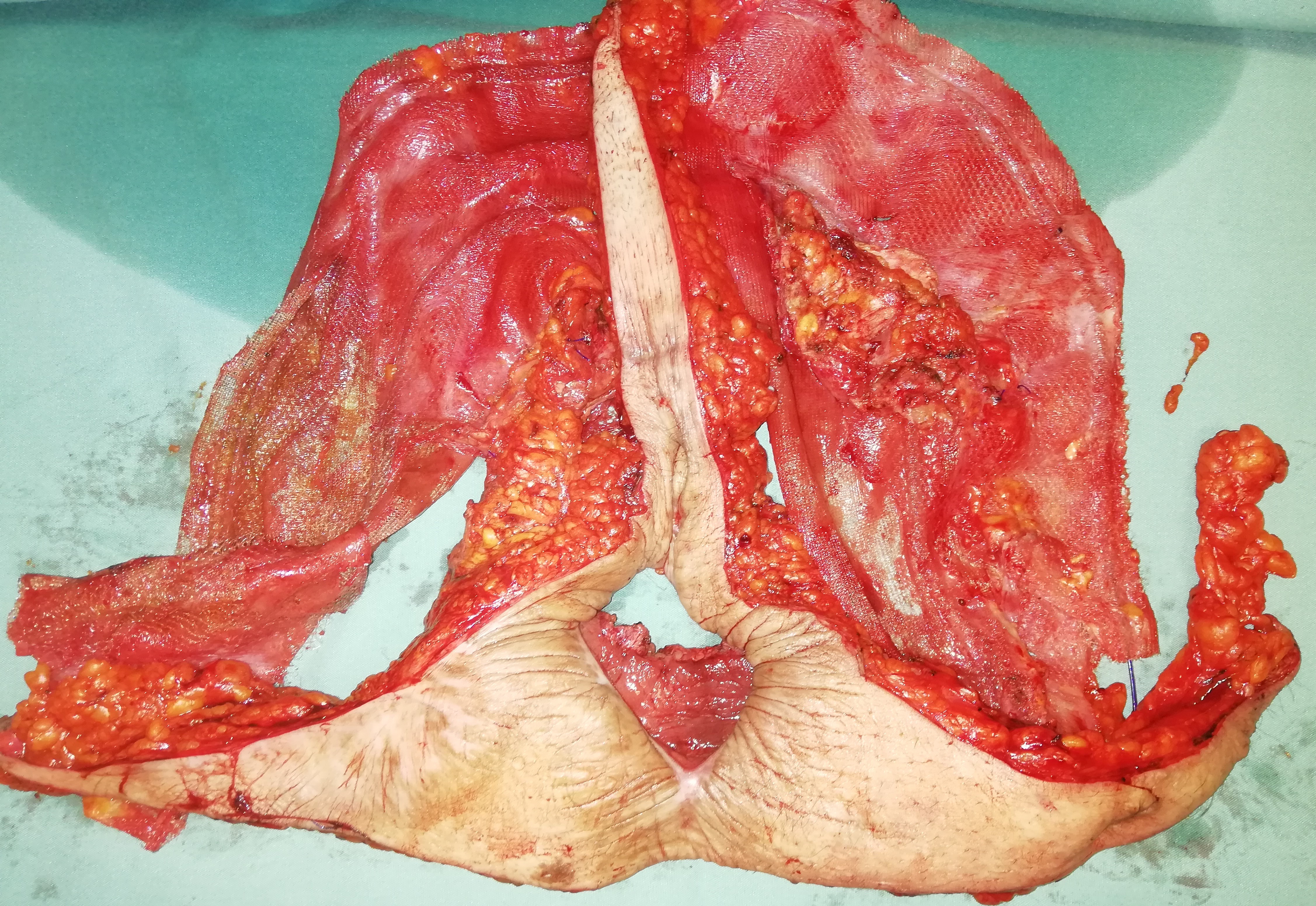 MESH INFECTION