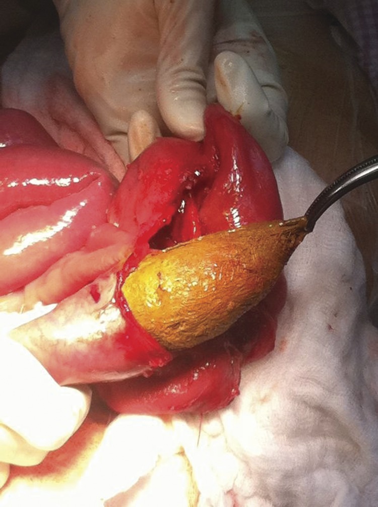 INTRALUMINAL SURGICAL SPONGE 