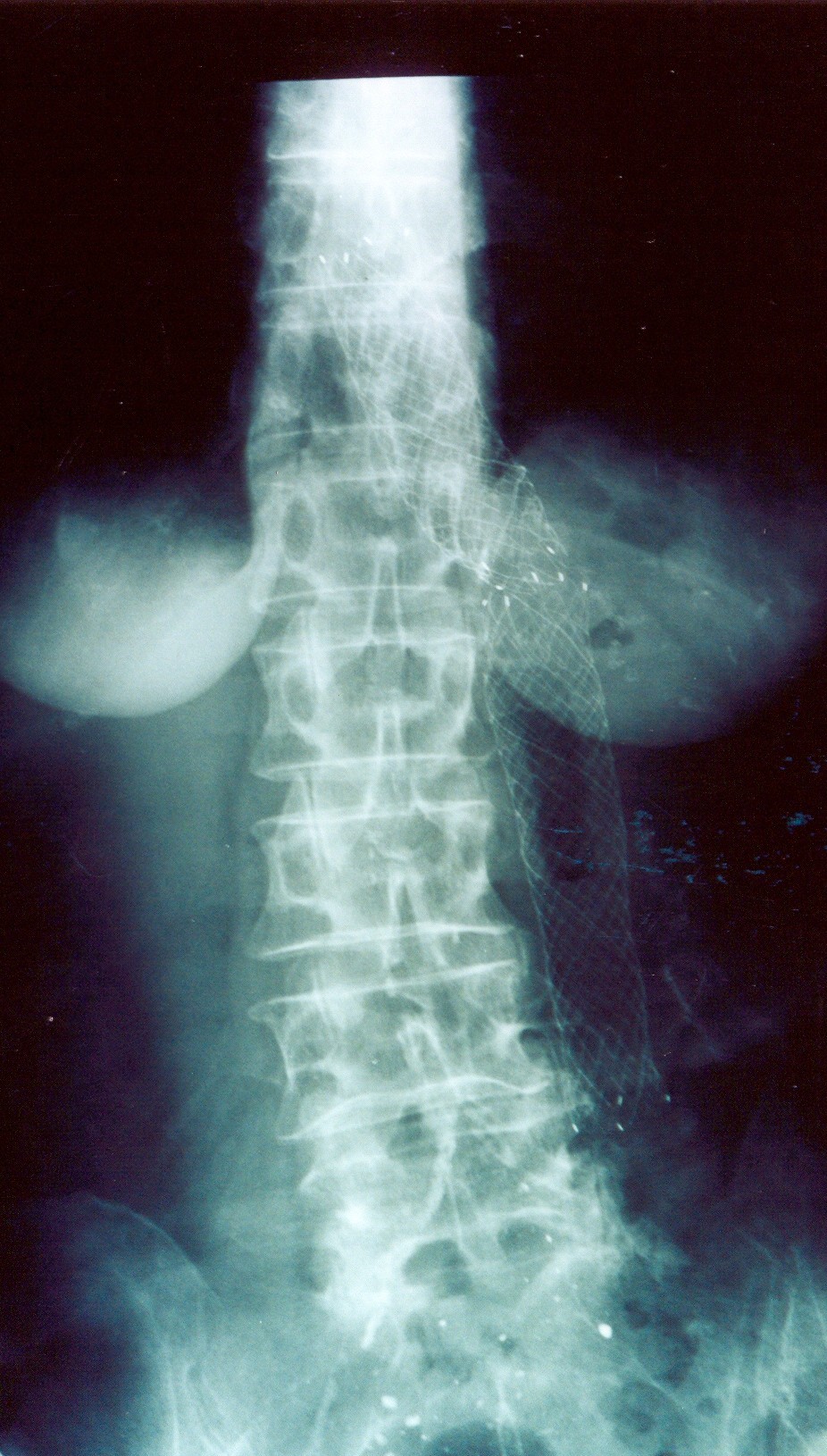 ESOPHAGO-JEJUNAL ANASTOMOSIS LEAK - STENT