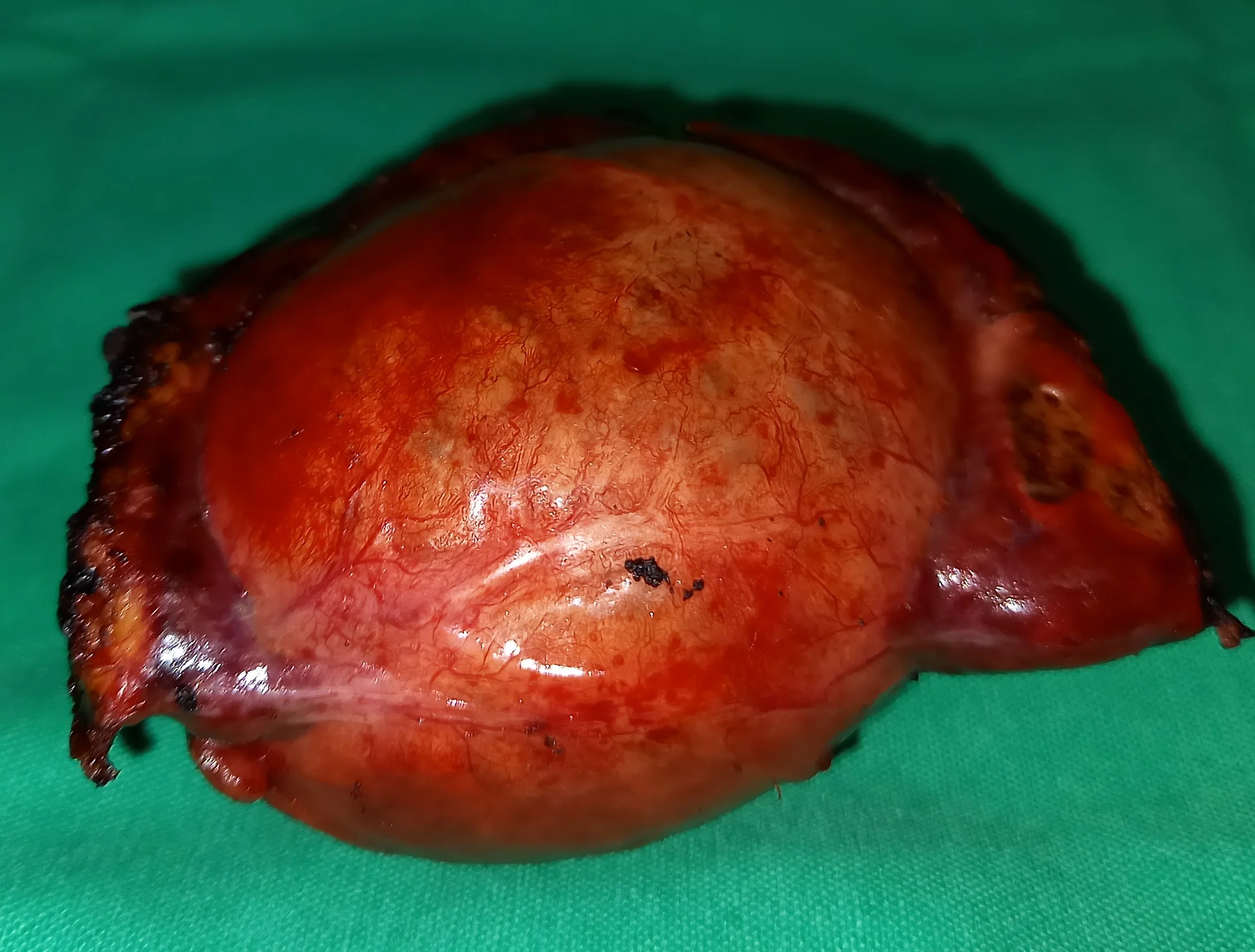 LIVER HYDATID CYST - HEPATECTOMY
