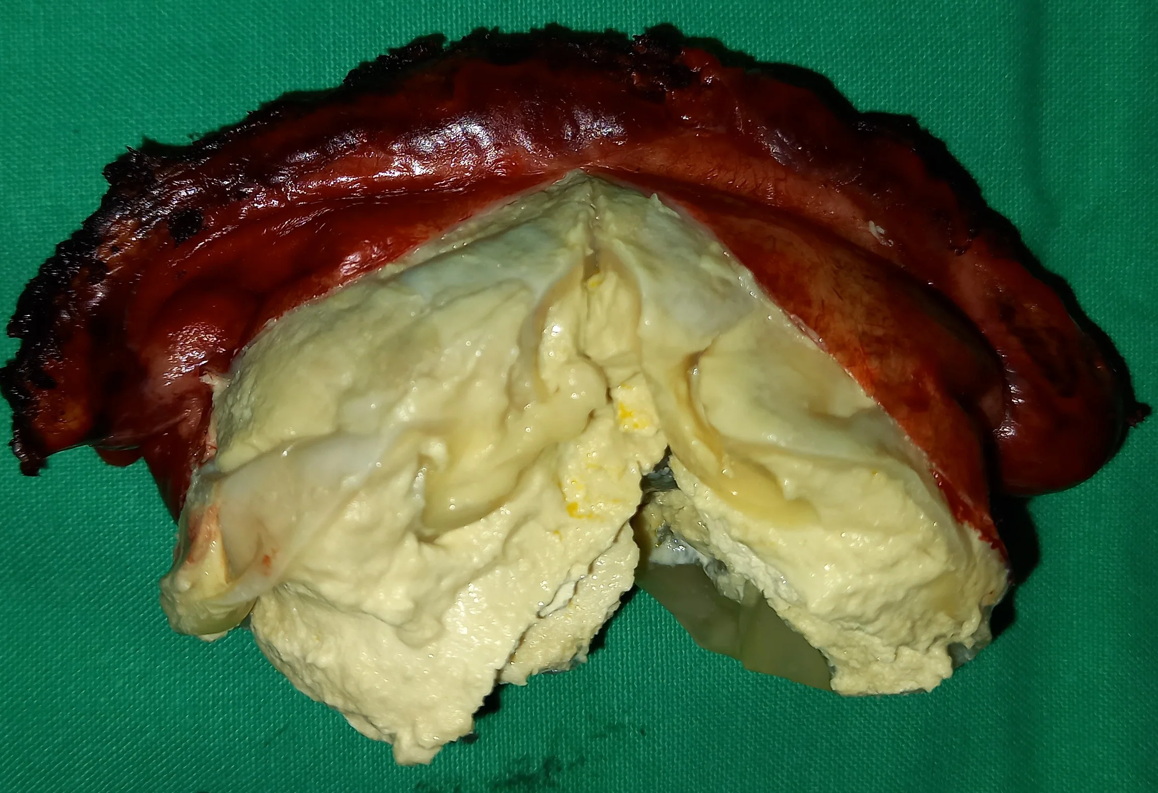 LIVER HYDATID CYST - HEPATECTOMY