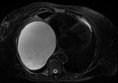 HYDATID CYST - LIVER