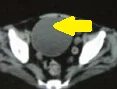 PRIMARY OMENTAL HYDATID CYST