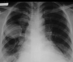 LUNG HYDATID CYST
