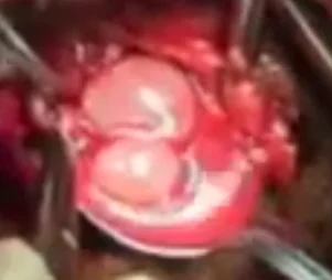 LUNG HYDATID CYST