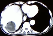 CONTAMINATED HYDATID CYST