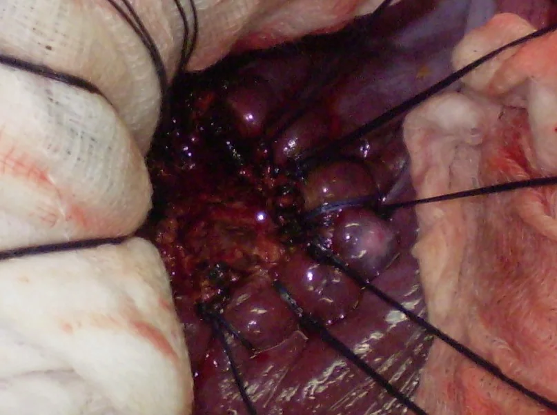 INTRAHEPATIC HYDATID CYST