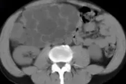 ALVEOLAR ECHINOCOCCOSIS