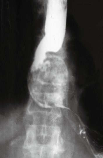 ASCARIS WORM IN ESOPHAGUS