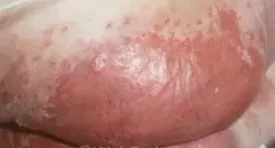 BREAST CADIDIASIS1