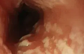 CANDIDA ESOPHAGITIS