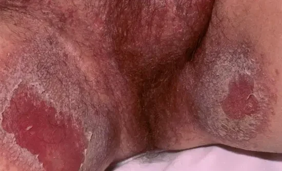 CUTENEOUS CADIDIASIS