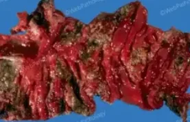 ENTAMOEBA HISTOLITICA