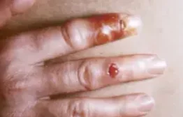 ERYTHEMA CONTAGIOSUM