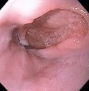 HIV ESOPHAGUS