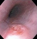HIV ESOPHAGUS