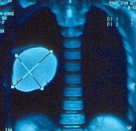 HYDATID CYST - LUNG