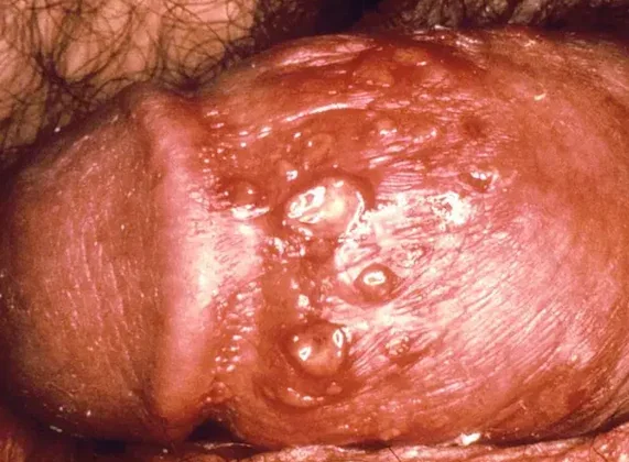 GENITAL HERPES