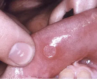 HERPES LABIALIS