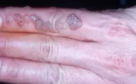 HUMAN PAPILLOMA VIRUS - HAND